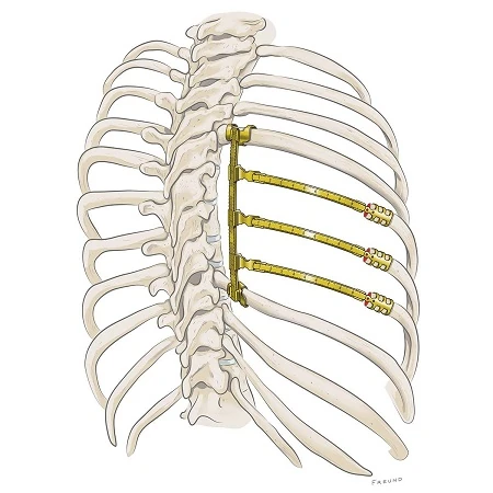 STRATOS - Reconstrucción Paravertebral