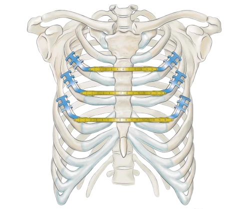 medxpert__stratos__pectus_carinatum.webp